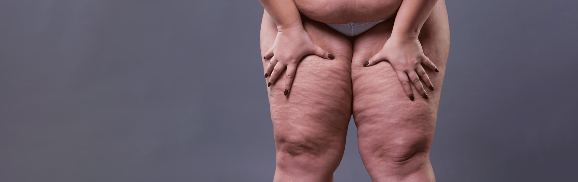 Lipödem erkennen: Typische Anzeichen bei hormonellen Veränderungen